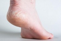 Cách chăm sóc gót chân khô, nứt nẻ trong mùa lạnh